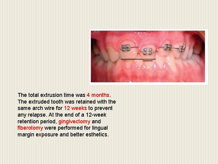 The total extrusion time was 4 months. The extruded tooth was retained with the