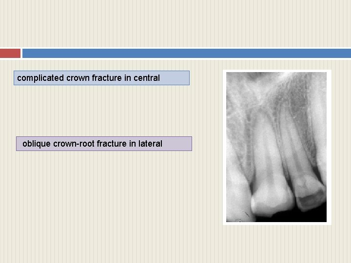 complicated crown fracture in central oblique crown-root fracture in lateral 