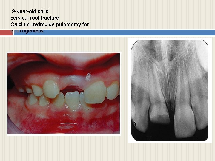 9 -year-old child cervical root fracture Calcium hydroxide pulpotomy for apexogenesis 