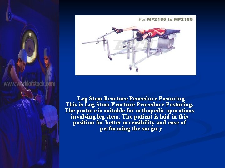 Leg Stem Fracture Procedure Posturing This is Leg Stem Fracture Procedure Posturing. The posture