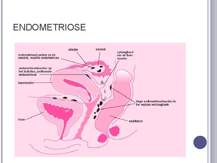 ENDOMETRIOSE 