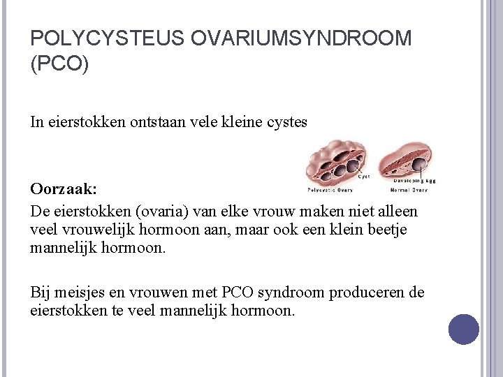 POLYCYSTEUS OVARIUMSYNDROOM (PCO) In eierstokken ontstaan vele kleine cystes Oorzaak: De eierstokken (ovaria) van