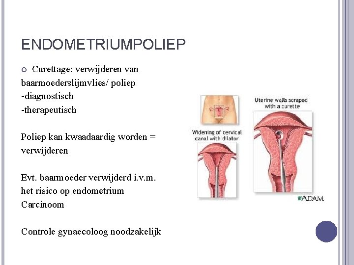 ENDOMETRIUMPOLIEP Curettage: verwijderen van baarmoederslijmvlies/ poliep -diagnostisch -therapeutisch Poliep kan kwaadaardig worden = verwijderen