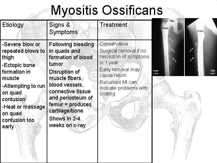 Myositis Ossificans Etiology Signs & Symptoms Treatment -Severe blow or repeated blows to thigh