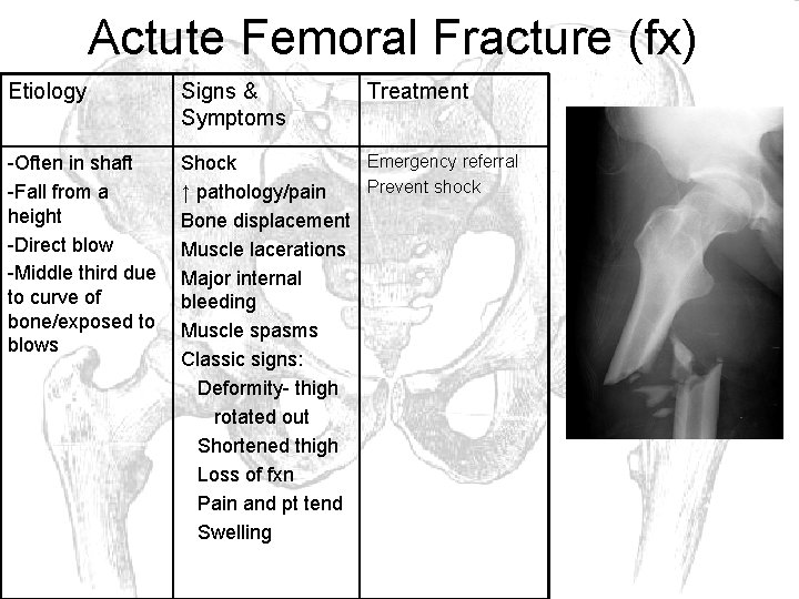 Actute Femoral Fracture (fx) Etiology Signs & Symptoms Treatment -Often in shaft -Fall from