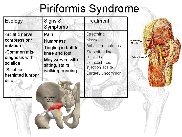 Piriformis Syndrome Etiology Signs & Symptoms Treatment -Sciatic nerve compression/ irritation -Common misdiagnosis with