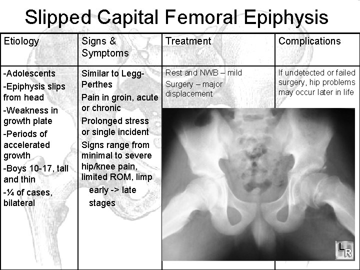 Slipped Capital Femoral Epiphysis Etiology Signs & Symptoms Treatment -Adolescents -Epiphysis slips from head