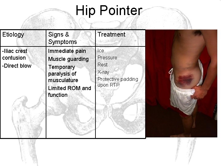 Hip Pointer Etiology Signs & Symptoms Treatment -Iliac crest contusion -Direct blow Immediate pain