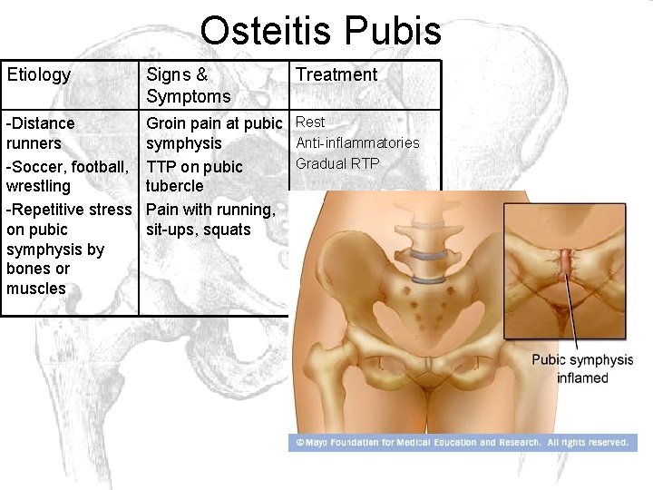 Osteitis Pubis Etiology Signs & Symptoms Treatment -Distance runners -Soccer, football, wrestling -Repetitive stress