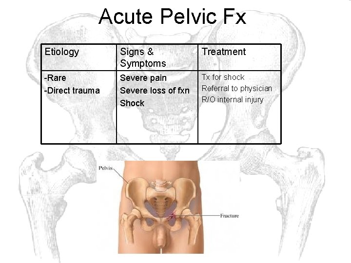 Acute Pelvic Fx Etiology Signs & Symptoms Treatment -Rare -Direct trauma Severe pain Severe