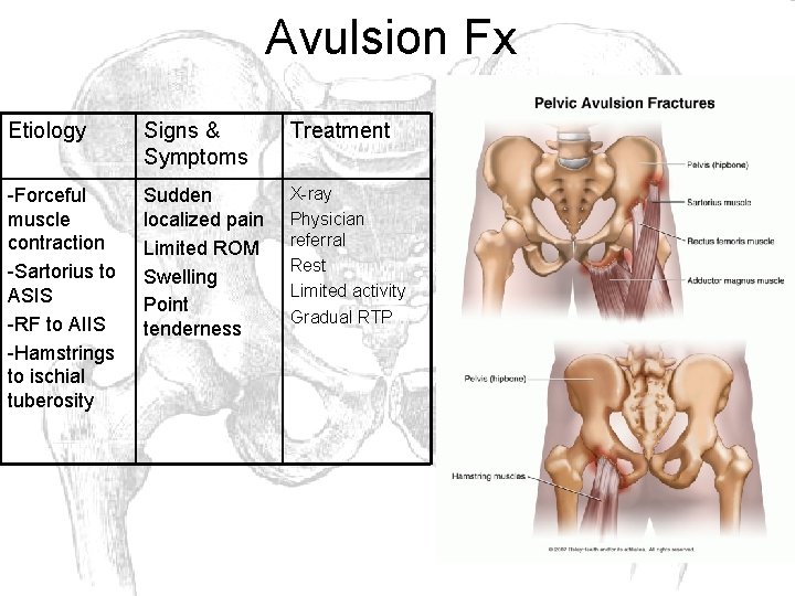 Avulsion Fx Etiology Signs & Symptoms Treatment -Forceful muscle contraction -Sartorius to ASIS -RF