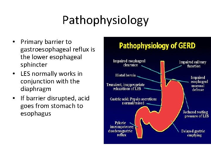 Pathophysiology • Primary barrier to gastroesophageal reflux is the lower esophageal sphincter • LES