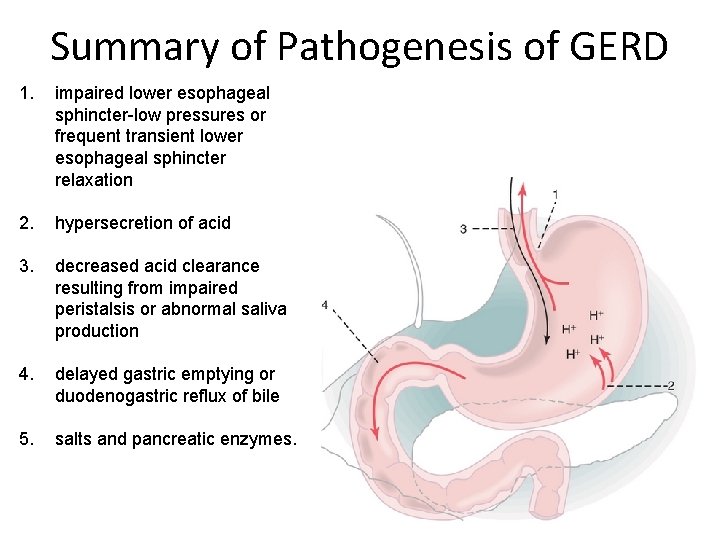 Summary of Pathogenesis of GERD 1. impaired lower esophageal sphincter-low pressures or frequent transient