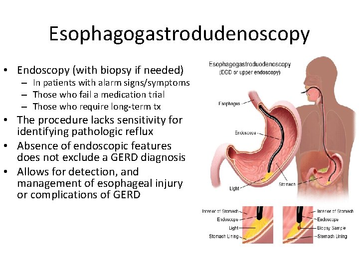 Esophagogastrodudenoscopy • Endoscopy (with biopsy if needed) – In patients with alarm signs/symptoms –