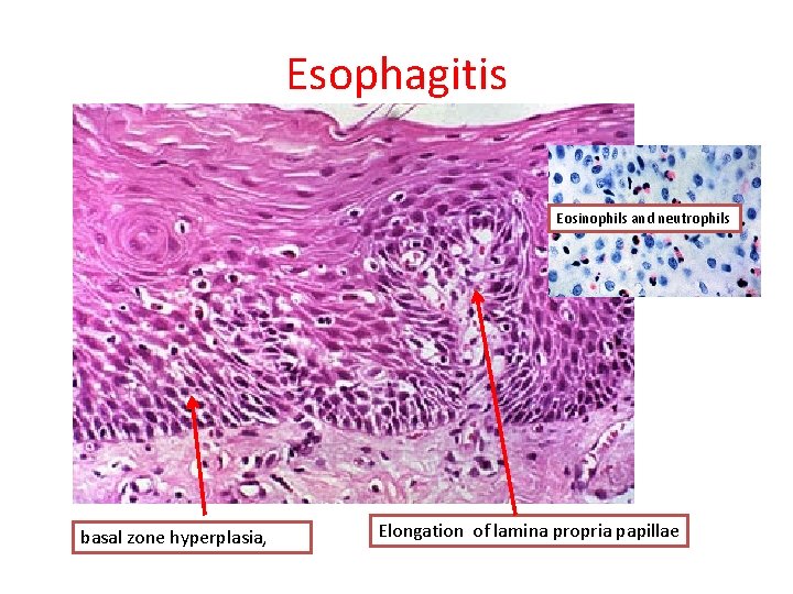 Esophagitis Eosinophils and neutrophils basal zone hyperplasia, Elongation of lamina propria papillae Esophagitis Eosinophils and neutrophils basal zone hyperplasia, Elongation of lamina propria papillae