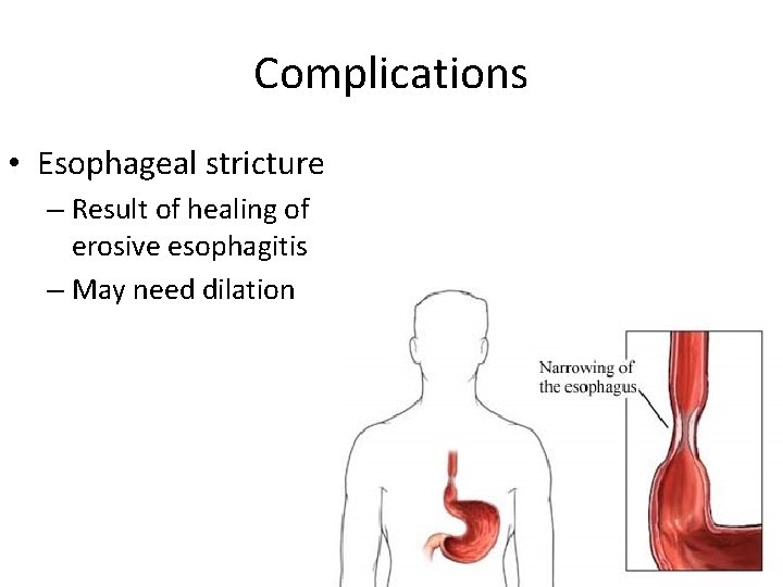 Complications • Esophageal stricture – Result of healing of erosive esophagitis – May need Complications • Esophageal stricture – Result of healing of erosive esophagitis – May need