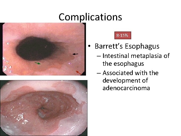 Complications 8 -15% • Barrett’s Esophagus – Intestinal metaplasia of the esophagus – Associated