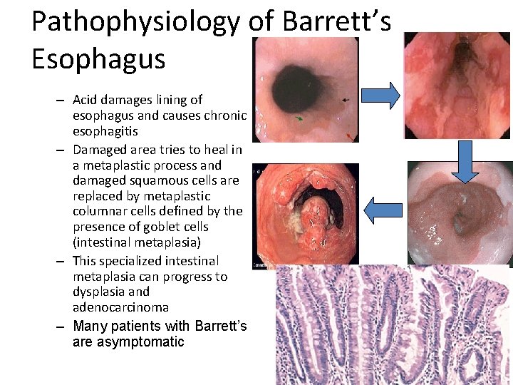 Pathophysiology of Barrett’s Esophagus – Acid damages lining of esophagus and causes chronic esophagitis Pathophysiology of Barrett’s Esophagus – Acid damages lining of esophagus and causes chronic esophagitis