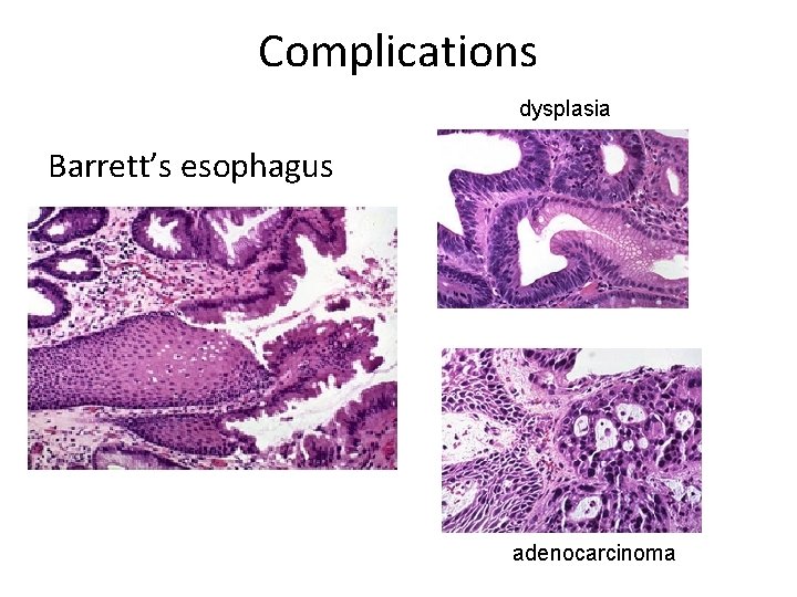 Complications dysplasia Barrett’s esophagus adenocarcinoma Complications dysplasia Barrett’s esophagus adenocarcinoma