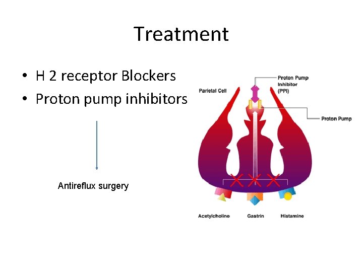 Treatment • H 2 receptor Blockers • Proton pump inhibitors Antireflux surgery 