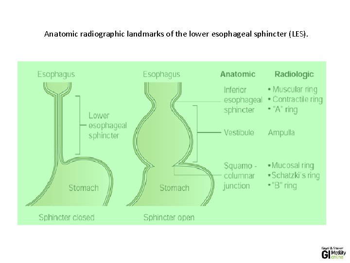 Anatomic radiographic landmarks of the lower esophageal sphincter (LES). Anatomic radiographic landmarks of the lower esophageal sphincter (LES).