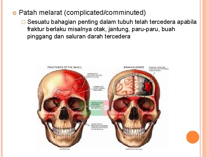  Patah melarat (complicated/comminuted) � Sesuatu bahagian penting dalam tubuh telah tercedera apabila fraktur