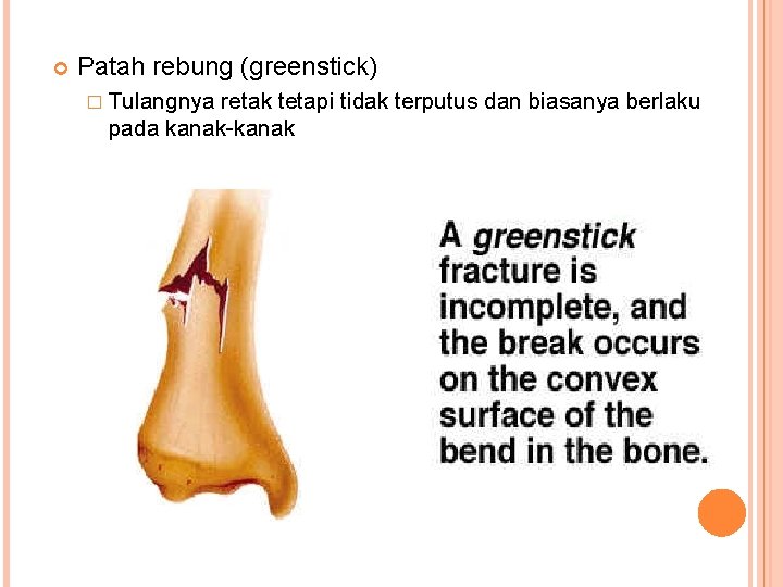  Patah rebung (greenstick) � Tulangnya retak tetapi tidak terputus dan biasanya berlaku pada