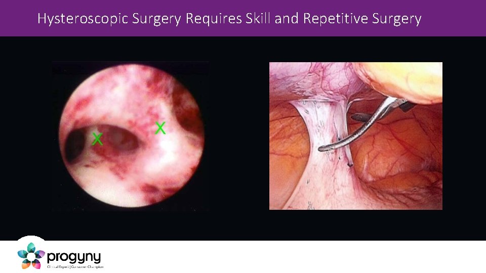 Hysteroscopic Surgery Requires Skill and Repetitive Surgery 