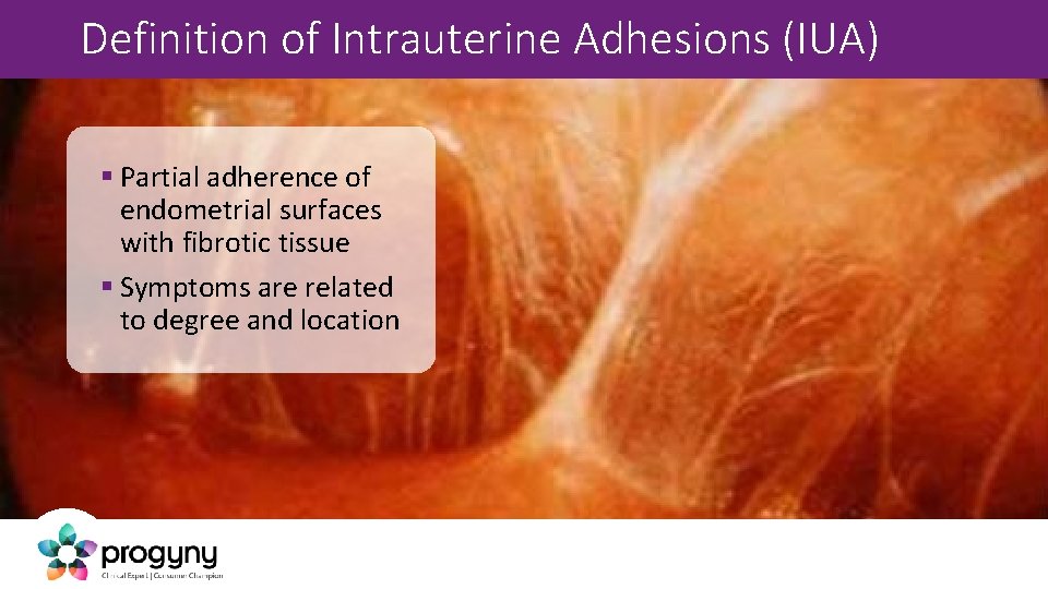 Definition of Intrauterine Adhesions (IUA) § Partial adherence of endometrial surfaces with fibrotic tissue