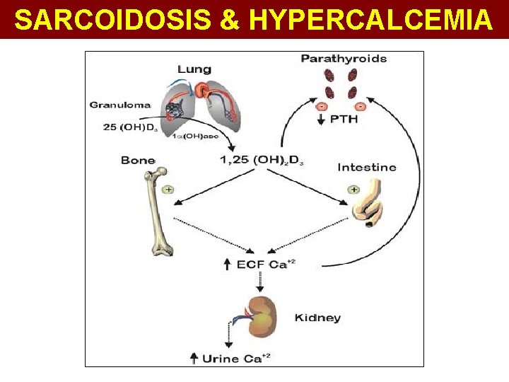 SARCOIDOSIS & HYPERCALCEMIA 