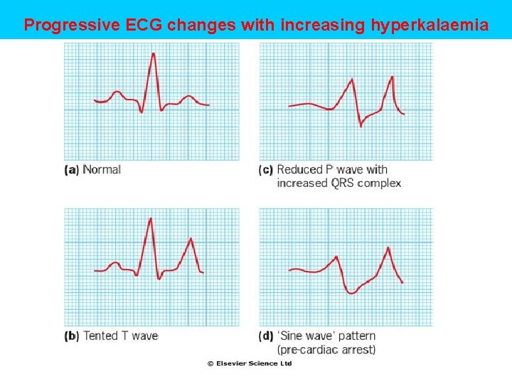 Progressive ECG changes with increasing hyperkalaemia 