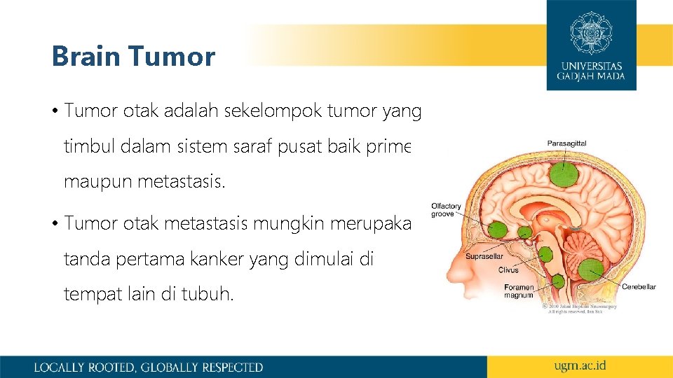 Brain Tumor • Tumor otak adalah sekelompok tumor yang timbul dalam sistem saraf pusat