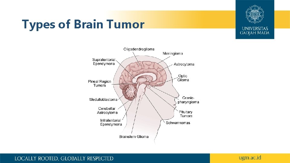 Types of Brain Tumor 
