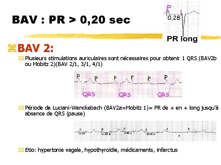 BAV : PR > 0, 20 sec z. BAV 2: y Plusieurs stimulations auriculaires