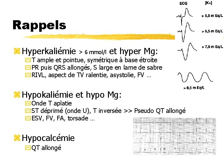 Rappels z Hyperkaliémie > 6 mmol/l et hyper Mg: y T ample et pointue,