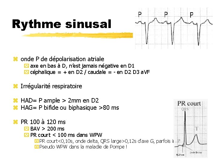 Rythme sinusal z onde P de dépolarisation atriale y axe en bas à D,