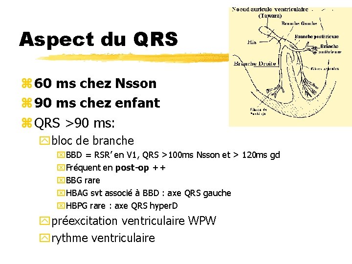 Aspect du QRS z 60 ms chez Nsson z 90 ms chez enfant z