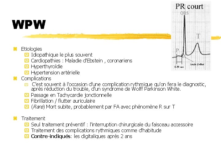 WPW z Etiologies y Idiopathique le plus souvent y Cardiopathies : Maladie d'Ebstein ,