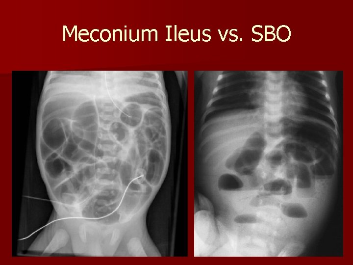 Meconium Ileus vs. SBO 