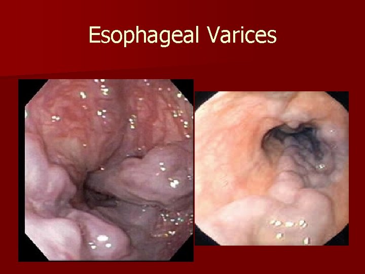 Esophageal Varices 