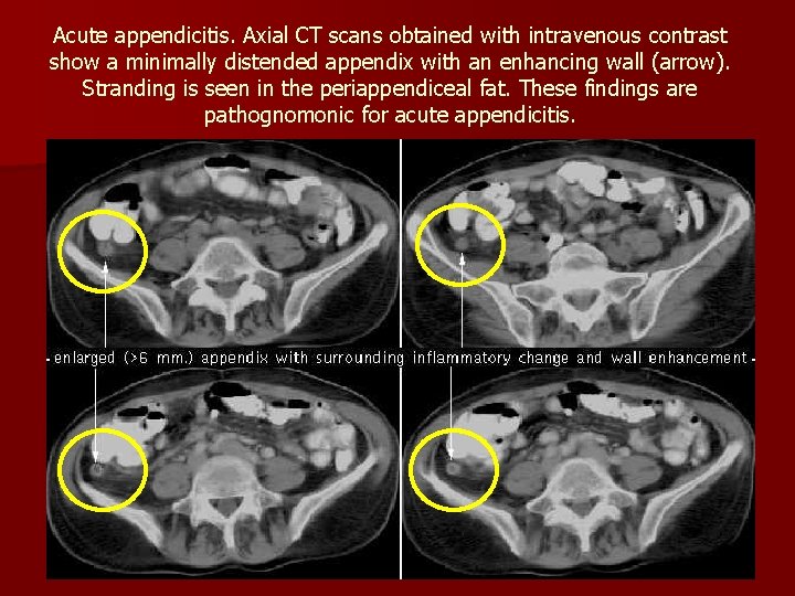 Acute appendicitis. Axial CT scans obtained with intravenous contrast show a minimally distended appendix