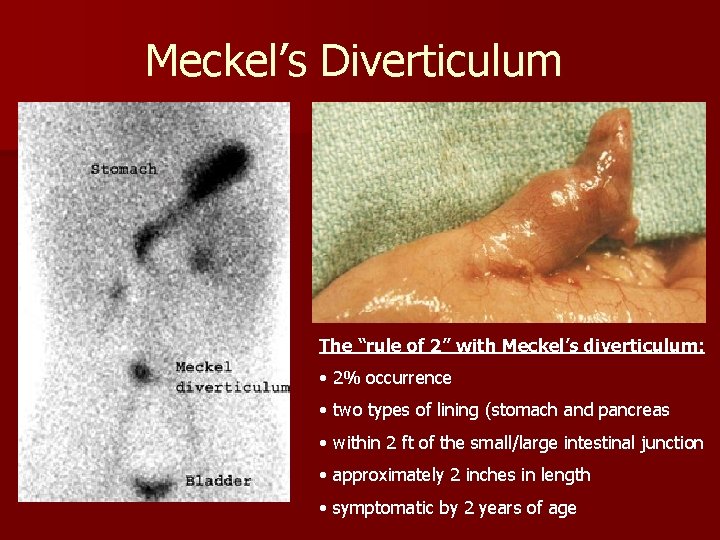 Meckel’s Diverticulum The “rule of 2” with Meckel’s diverticulum: • 2% occurrence • two