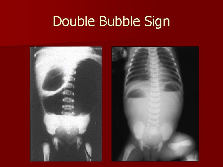 Double Bubble Sign 