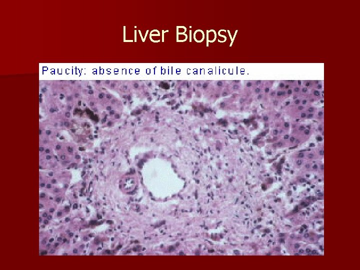 Liver Biopsy 