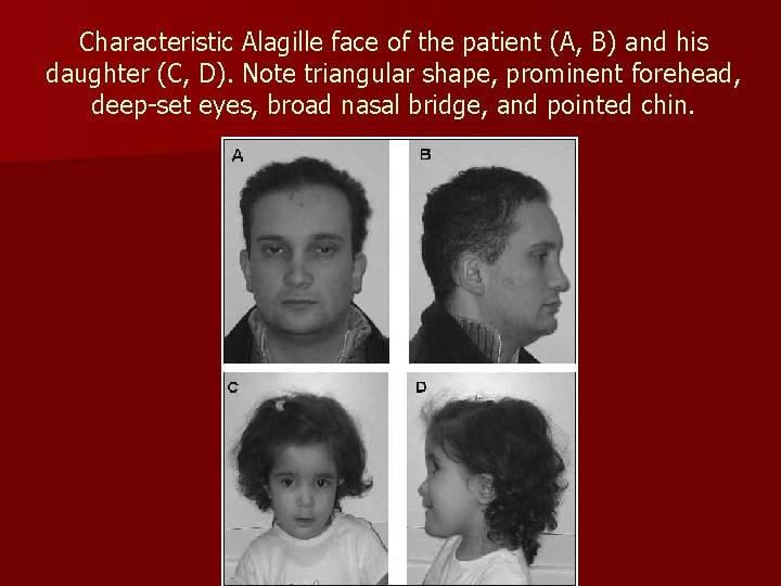 Characteristic Alagille face of the patient (A, B) and his daughter (C, D). Note