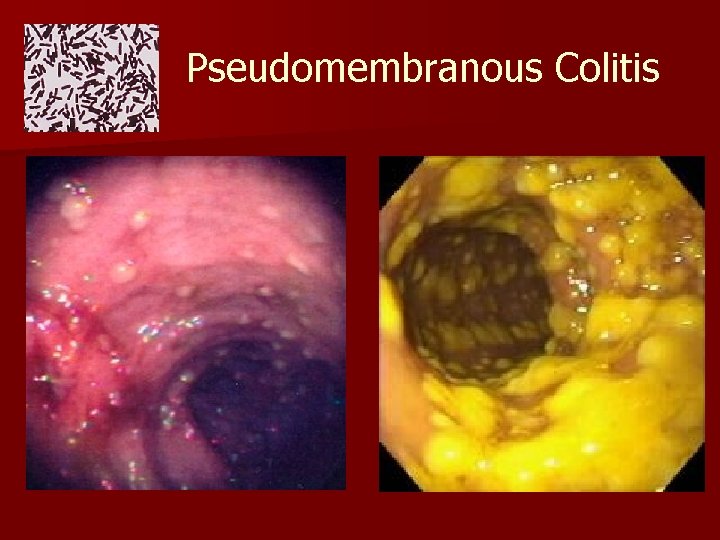 Pseudomembranous Colitis 