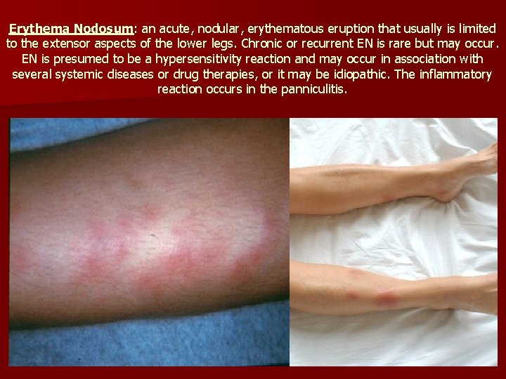 Erythema Nodosum: an acute, nodular, erythematous eruption that usually is limited to the extensor