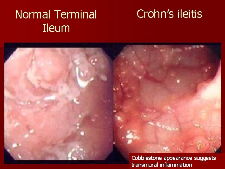 Normal Terminal Ileum Crohn’s ileitis Cobblestone appearance suggests transmural inflammation 