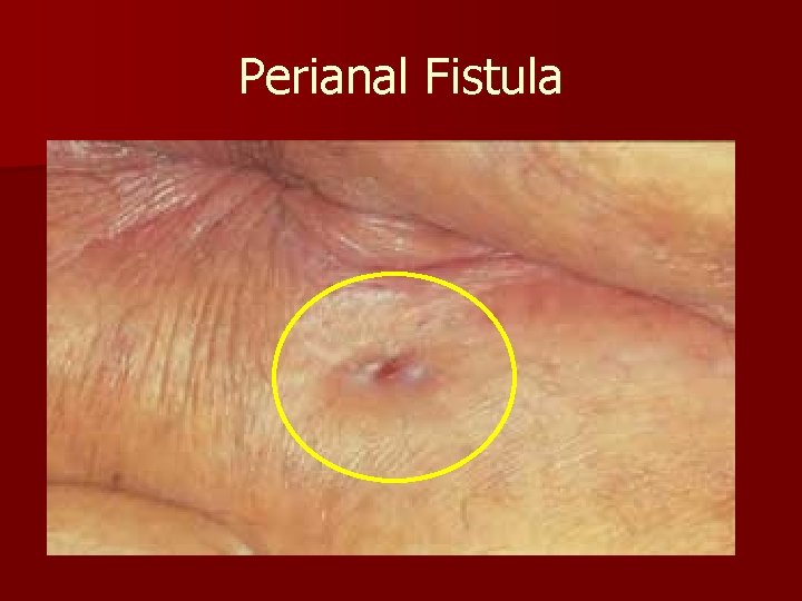 Perianal Fistula 