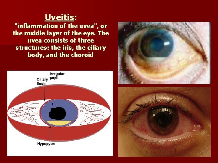 Uveitis: "inflammation of the uvea", or the middle layer of the eye. The uvea